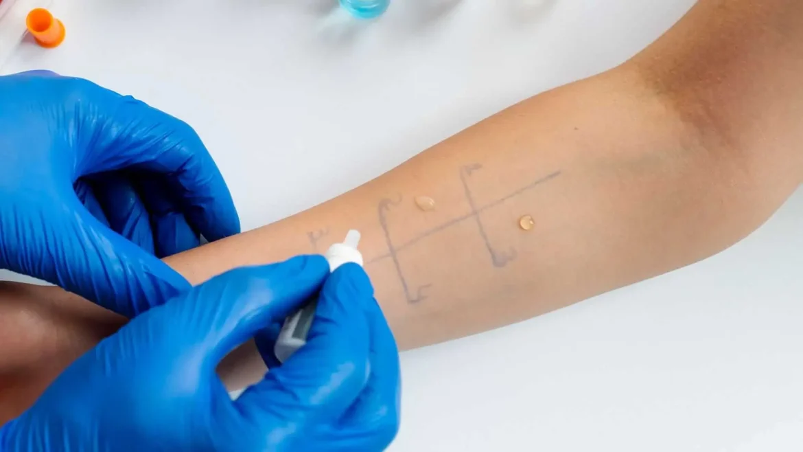 Pruebas Cutaneas de Alergia